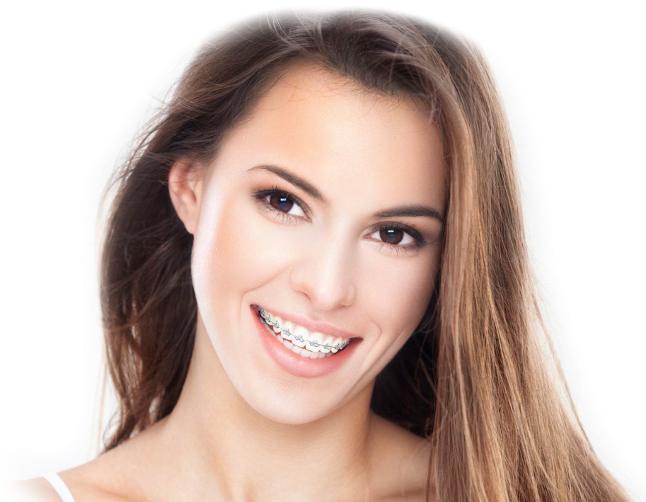 Брекет-система