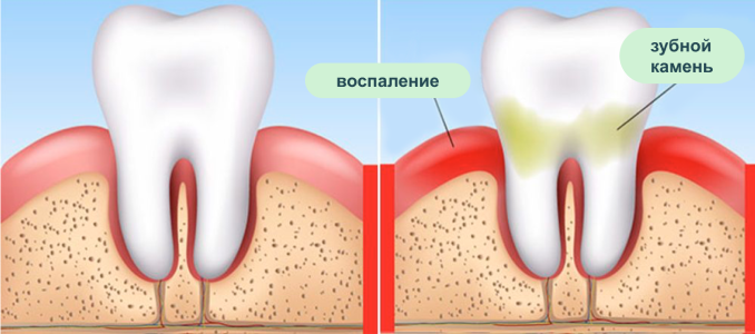 гингивит-фото3.png гингивит-фото3.png