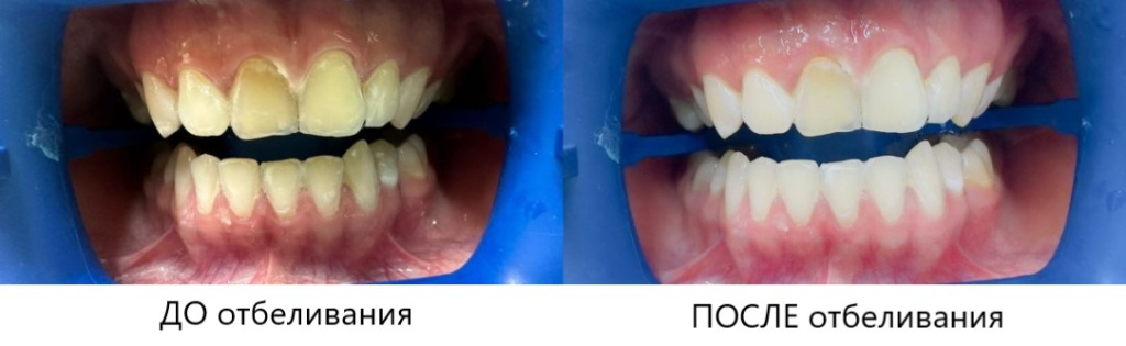отбеливание.jpg
