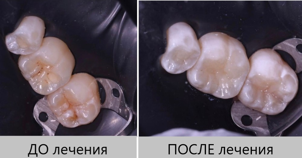 детский кариес.jpg детский кариес.jpg
