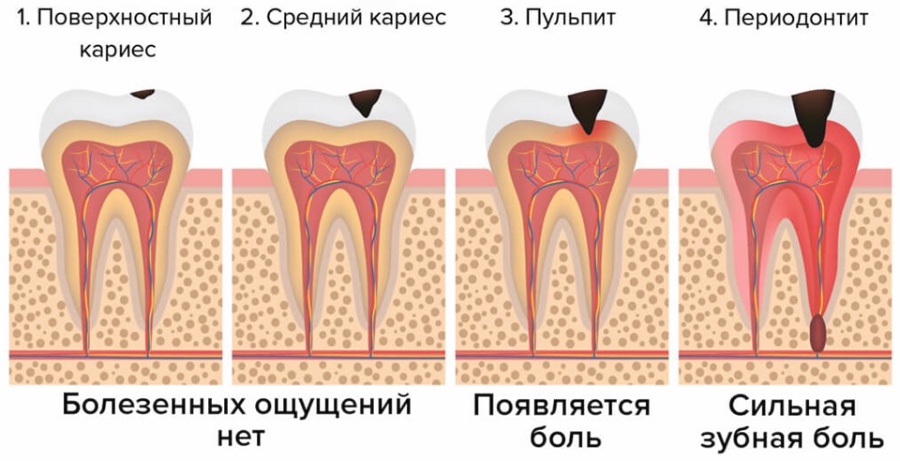 Пульпит: почему лечение нельзя откладывать?