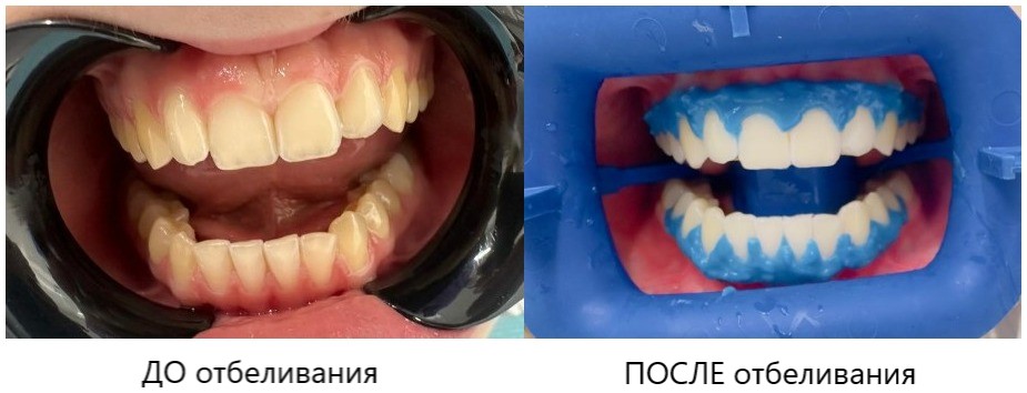 отбеливание ДО и ПОСЛЕ ЗУМ.jpg