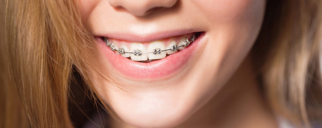 metallicheskie-brekety.jpg metallicheskie-brekety.jpg