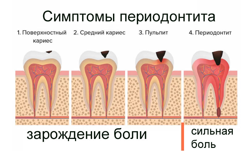 periodontitzub2b.jpg