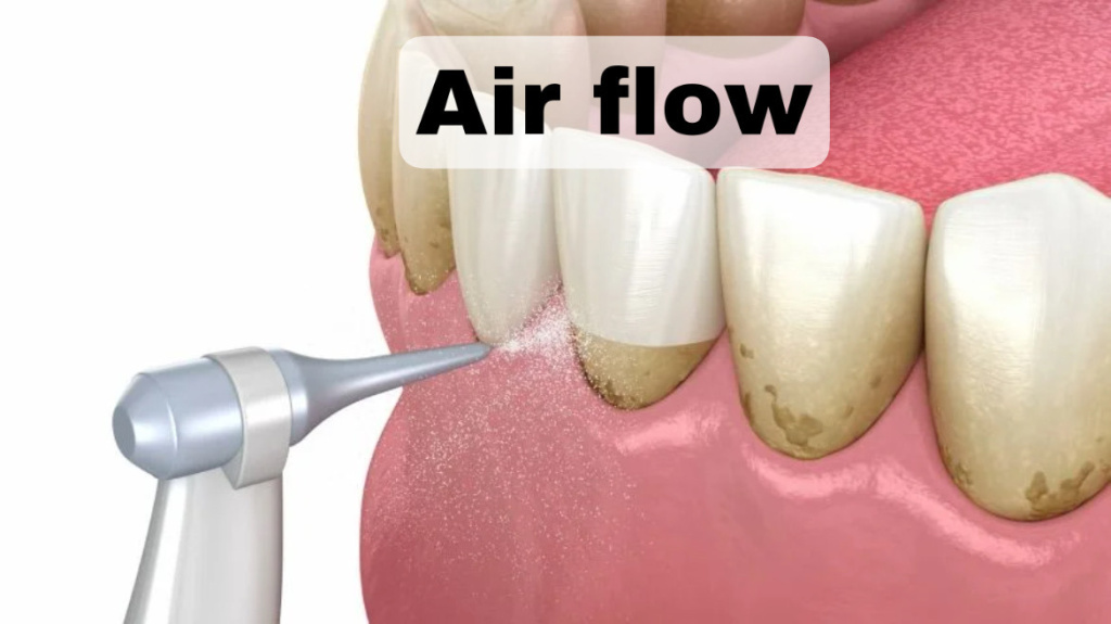 prof-chistka-zubov-air-flow.jpeg
