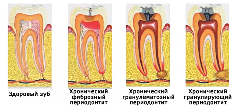 tipy-periodontita.jpg